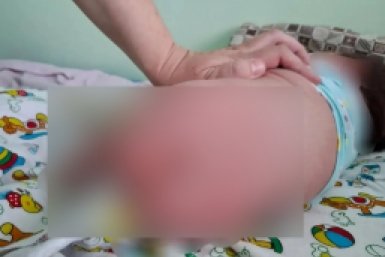 В Бурятии спасли новорожденную с редкой опухолью таза