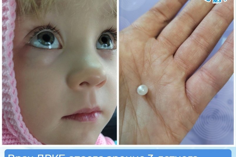 В Бурятии 3-летняя девочка затолкала бусину в глаз
