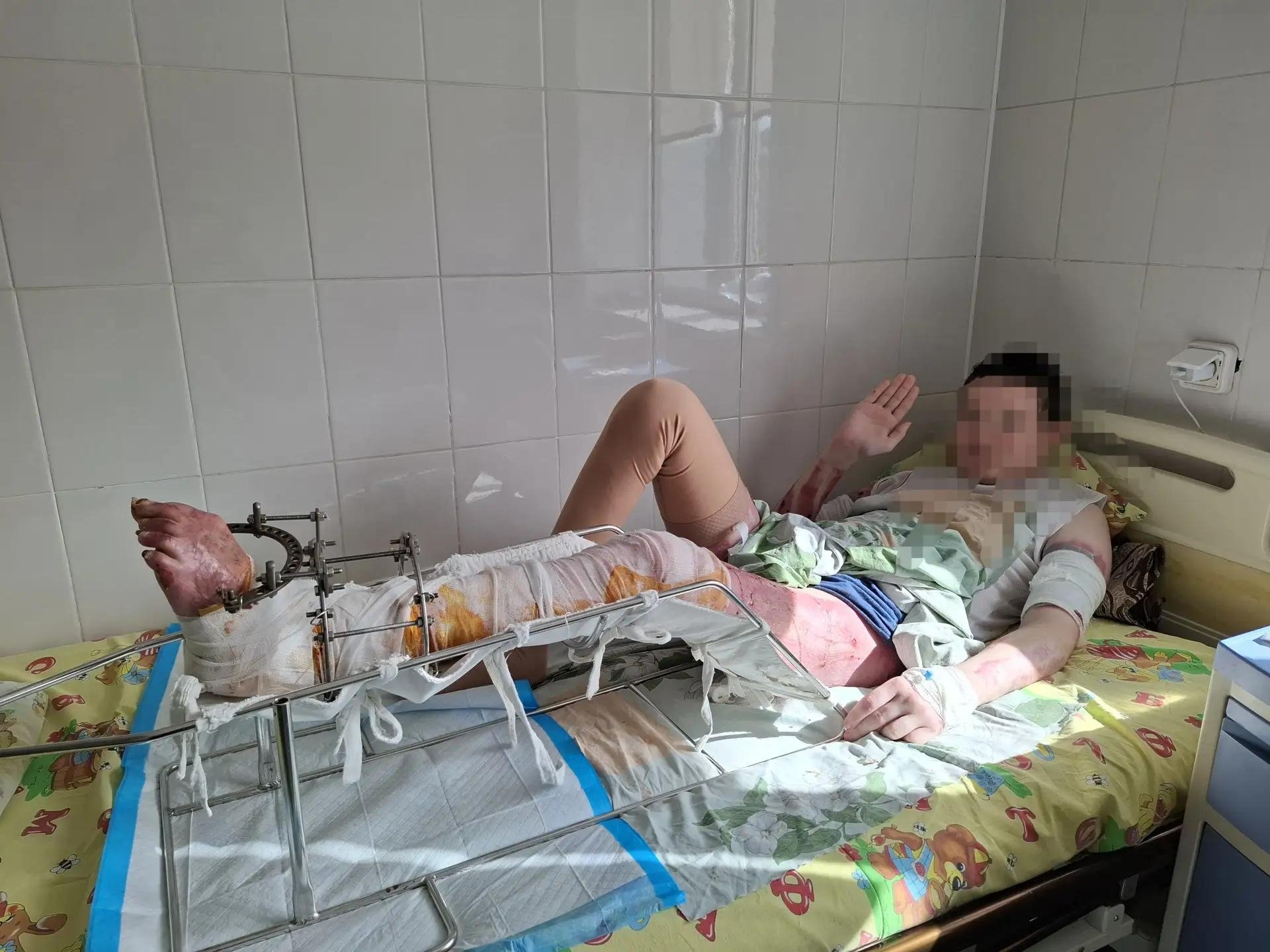 Мальчик находился в состоянии глубокого ожогового шока ДРКБ Бурятии